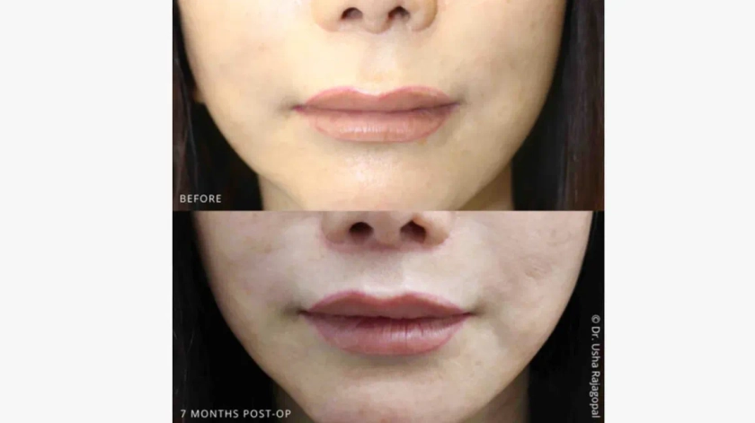Bullhorn Lip Lift: Procedure, Cost, What to Expect, & More